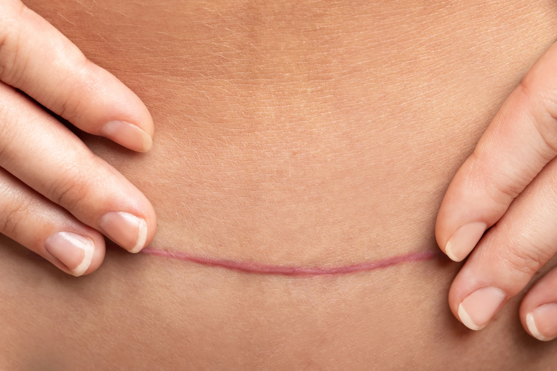 Cicatriz cirúrgica horizontal na região abdominal em fase de cicatrização