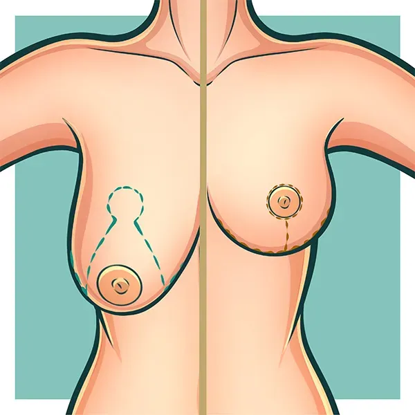 Mastopexia-Sem-Protese