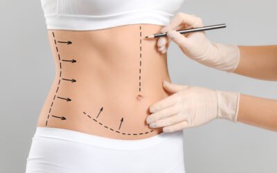 Abdominoplastia
